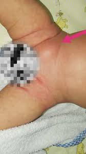 Image result for Inguinal hernia child