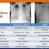 Learn about different types of pleural effusions, including symptoms, causes, and treatments. Https Encrypted Tbn0 Gstatic Com Images Q Tbn And9gcsum B7h9cymguzgfvelmvtxedwaek4avaafeq7hnnt5drxruch Usqp Cau