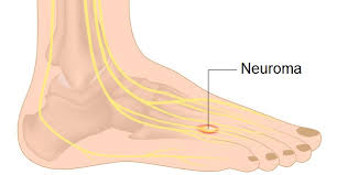 Peripheral Neuropathy Treatment Via Reflexology For Hands