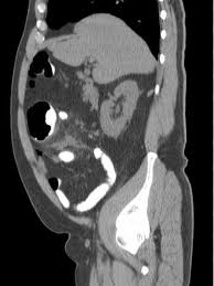 Image result for phlegmon on face)