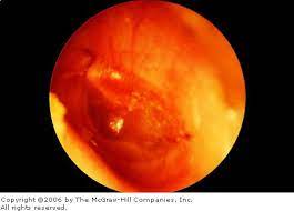 Early Acute Otitis Media A Mildly Erythematous Tympanic Membrane Is Seen With A Small Purulent Effusion In The Middle Ear Courtesy Of C B Kedokteran