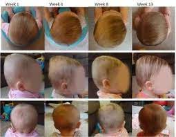 22 Flat Head Syndrome In Babies Plagiocephaly Brachycephaly Ideas Flat Head Syndrome Flat Head Flat Head Baby
