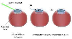 Does Medicare Cover Laser Cataract Surgery Detroit Mi