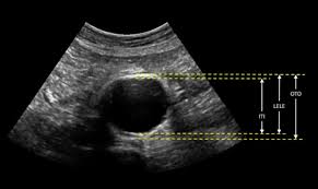 Blood supply to abdominal digestive organs(and the spleen)•three unpairedbranches of abdominal aorta•vessels (and nerves) travel through dorsal. Editor S Choice European Society For Vascular Surgery Esvs 2019 Clinical Practice Guidelines On The Management Of Abdominal Aorto Iliac Artery Aneurysms European Journal Of Vascular And Endovascular Surgery