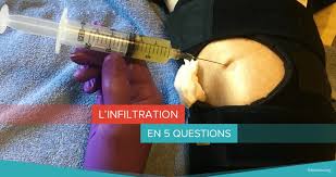 L'arthrose touche les genoux, les hanches, la colonne vertébrale mais aussi les mains, les doigts ce qui peut compliquer les gestes les plus simples. Infiltrations Qu Est Ce Que C Est