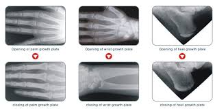 Image result for Hand Growth Plates
