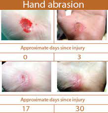 Here's how to look after wounds, cuts and grazes and when beginning of content. Observance Of Wound Healing In The Aesthetic Setting