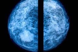 Sent straight for ultrasound scan and had a marker place inside. Dense Breast Tissue How 3d Mammograms Other Tests Help Find Hidden Cancers Health Essentials From Cleveland Clinic