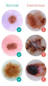 What is the treatment and prognosis for skin cancer? Molescope Skin Cancer Signs Symptoms