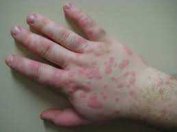 This is often triggered by cold or emotional stress. Erythema Types Causes Symptoms And Treatments