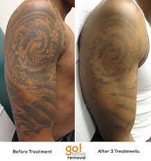 After 3 Laser Tattoo Removal Treatments There Is Significant Fading On This Black And Grey Tattoo Grey Wash Laser Tattoo Laser Tattoo Removal Sleeve Tattoos