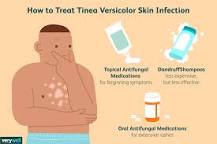 Image result for what is the best over the counter treatment for tinea versicolor