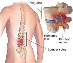 Melansir medical news today, cedera ini mungkin melibatkan otot. Cara Mengobati Sakit Pinggang Sebelah Kiri Secara Alami Obat Sariawan Pada Anak