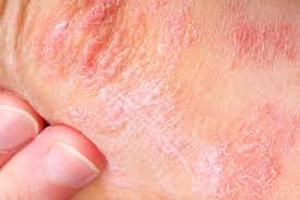 Image result for psoriasis