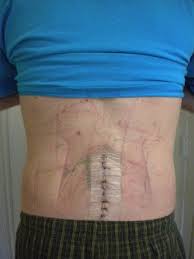 Pin On Back Surgery Before During After