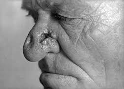 Image result for Tertiary Syphilis