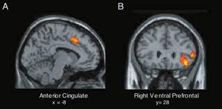 The present paper describes a reliable method for the assessment of the hippocampus, the anterior cingulate cortex, the retrosplenial. A Increased Activity In Anterior Cingulate Cortex Acc During Download Scientific Diagram