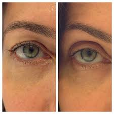 Maybe you would like to learn more about one of these? Want An Eye Lift Without Surgery Here S How Allure