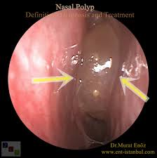 How to cure nasal polyps at home. Nasal Polyp Definition Symptoms Diagnosis And Treatment