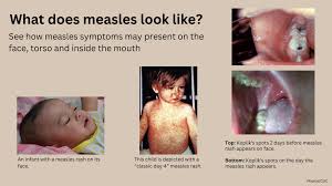Image result for measles