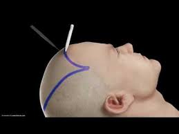 Asmed Dr Koray Erdogan 3621 Grafts Repair Operation Des Manual Grafting Hair Transplant Doctor