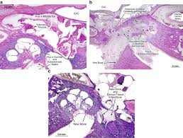 Image result for Bacterial Labyrinthitis