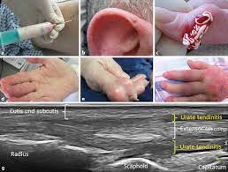 Increased nucleic acid turnover due to leukemia/lymphoma, chronic renal. Crystal Arthritides Gout And Calcium Pyrophosphate Arthritis Springerlink