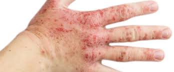 Image result for dermatitis contacta allergica
