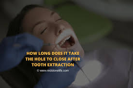 • if the tooth was removed with minimal trauma to the surrounding tissues (especially the bone), the hole is expected to seal close up withing the second or third day. How Long Does It Take The Hole To Close After Tooth Extraction Find Out