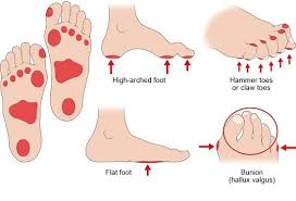 Image result for diabetic toes