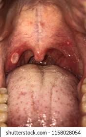 Image result for Mouth ulcers symptoms roof of the mouth