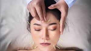 Acupuncture Pinellas Park FL