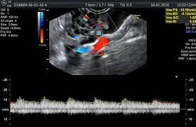 The tumor is being supplied by feeder arteries. Ultrasonographic Color Doppler Appearance Of The Ovaries With Moderate Download Scientific Diagram