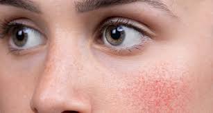 The bisoporol seems to be the culprit. Rosacea Awareness Month What Aesthetic Treatments Help Rosacea