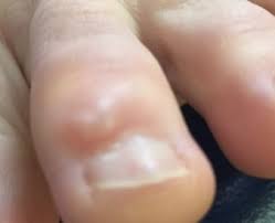 Here are some tips to help i love to blog!! Treatment Of Painful Tumors Of The Foot Beaver Valley Foot Clinic