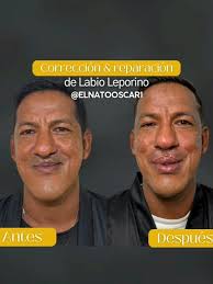 Increíble Transformación: Labio Leporino Antes y Después