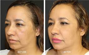Reduce asymmetrical appearance, restoring a more balanced look to your nose and helping it appear more proportional to your face. Before After Facial Fat Transfer Contour Aesthetic Center