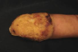 It may grow slowly and it's typically treatable. Skin Cancer In People Of Color Statistics Pictures And Prevention Goodrx
