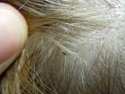 How To Get Rid Of Head Lice In Children Naturally Head Louse Head Lice Pictures Hair Nits
