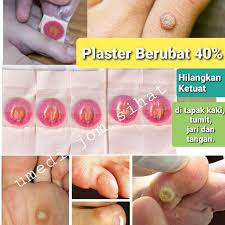 Ini kerana sedikit kesilapan boleh mendatangkan kecederaan ataupun luka. Plaster Ubat Merawat Ketuat Tapak Kaki Jari Tangan 5 Keping Shopee Malaysia