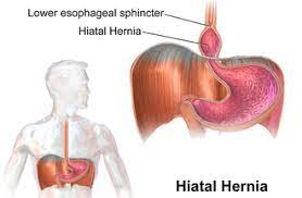 But a large hiatal hernia can allow food and acid to back up into your esophagus, leading to heartburn. Hiatal Hernias Are The Hidden Cause Of Numerous Health Problems