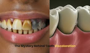 Image result for Tooth Discoloration