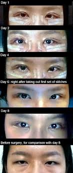 The Many Stories Behind Double Eyelid Surgery Code Switch Npr