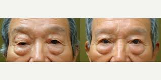 Jeffrey M. Joseph, MD, Oculoplastic Surgeon, Board Certified in  Ophthalmology