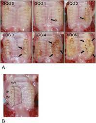 Pain or tenderness of your jaw. Zoledronic Acid Increases The Prevalence Of Medication Related Osteonecrosis Of The Jaw In A Dose Dependent Manner In Rice Rats Oryzomys Palustris With Localized Periodontitis Sciencedirect