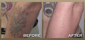 Tattoo removal in east los angeles on yp.com. Wrinkle Removal Los Angeles The Skinpeccable Team Offers Excellent Services In Facials And Welcome Walk Ins A Tattoo Removal Tattoo Removal Cost Laser Tattoo