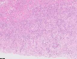 Posted in mesothelioma tagged biphasic mesothelioma pathology outlines, biphasic pleural mesothelioma causes, epithelioid mesothelioma, how does mesothelioma kill you,. Pathology Outlines Mesothelioma Pleura Epithelioid