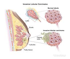 Image result for Breast Cancer