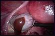 Kyste endometriosique ovarien