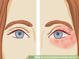 How To Treat Eczema Around The Eyes How To Treat Eczema Eczema Around Eyes Face Eczema
